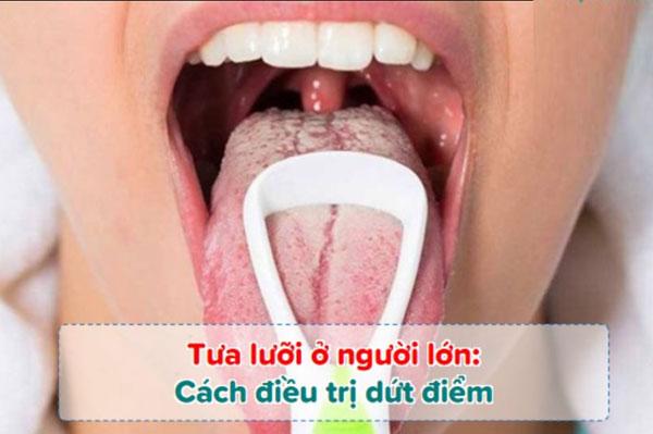 3 cách trị lưỡi trắng ở người lớn đơn giản, hiệu quả