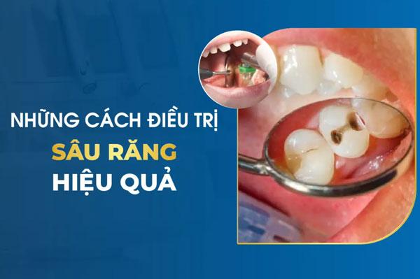 9 cách trị sâu răng đơn giản tại nhà mang lại hiệu quả cao