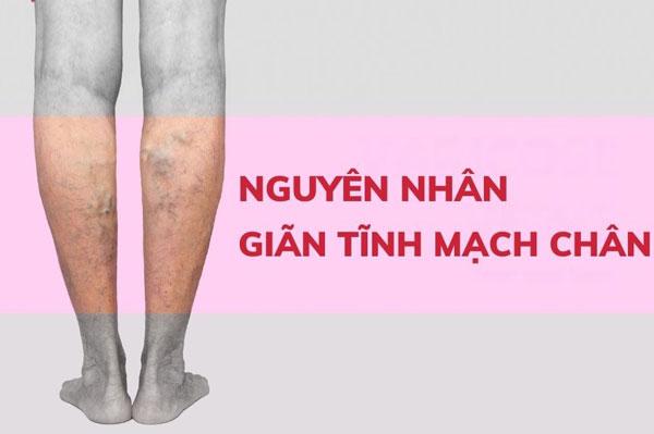 Bệnh giãn tĩnh mạch: Nguyên nhân và cách điều trị