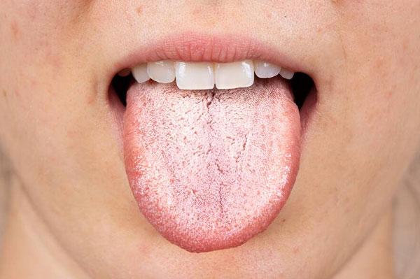 Cách điều trị lưỡi trắng: 3+ phương pháp đơn giản, hiệu quả
