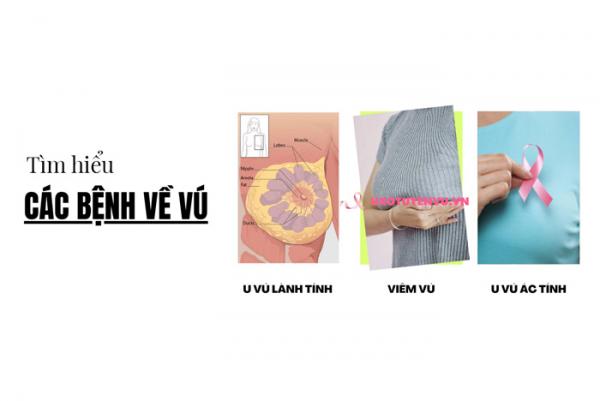 Đau nhức vú là bệnh gì? Tìm hiểu các bệnh lý liên quan đến vấn đề về vú