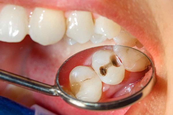Điểm danh 3 nguyên nhân gây sâu răng không phải ai cũng biết