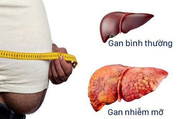 Nguyên nhân, triệu chứng của căn bệnh gan nhiễm mỡ