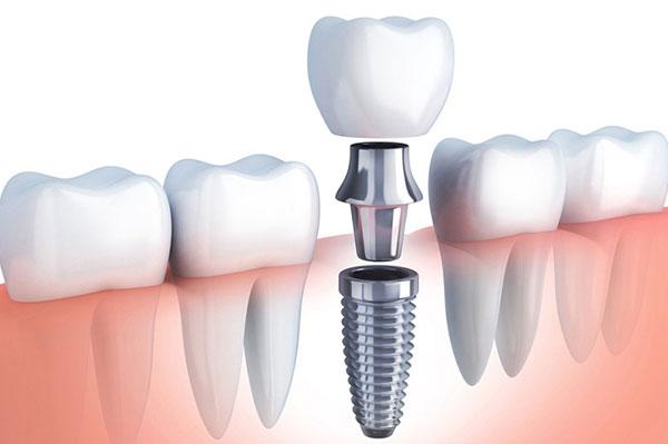 Những tiêu chí chọn trụ răng Implant phù hợp đạt hiệu quả tốt nhất