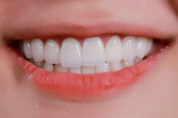 Răng cửa là gì? Những điều bạn cần biết về cấu tạo răng cửa