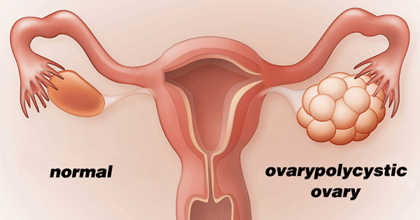 Hình ảnh từ trái qua phải, buồng trứng bình thường và xuất hiện nhiều u nang