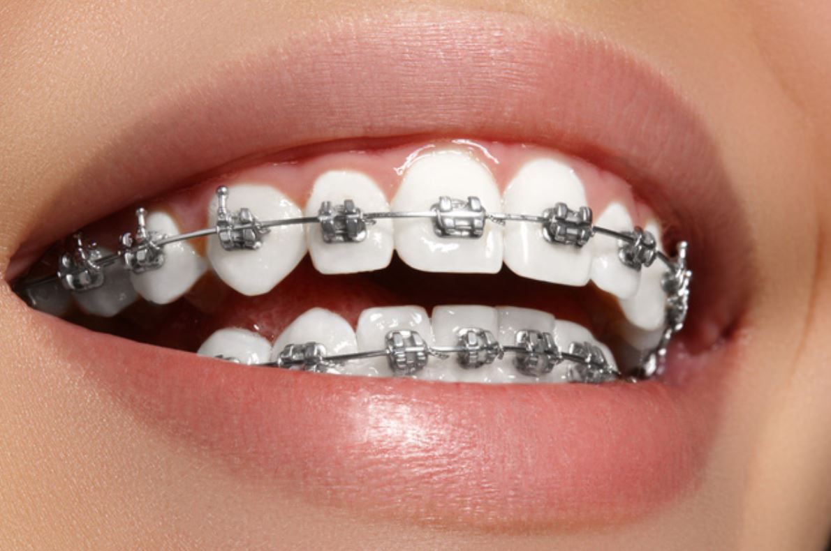 Niềng răng giúp bạn cải thiện được khớp cắn, phát âm