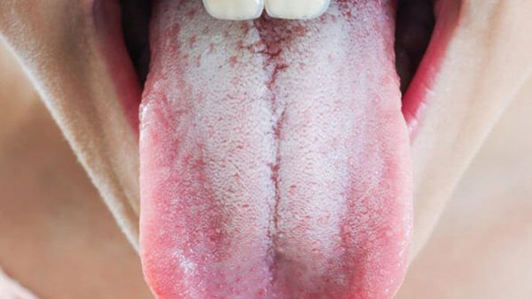 Lưỡi trắng thường kèm hôi miệng gây tự ti khi giao tiếp