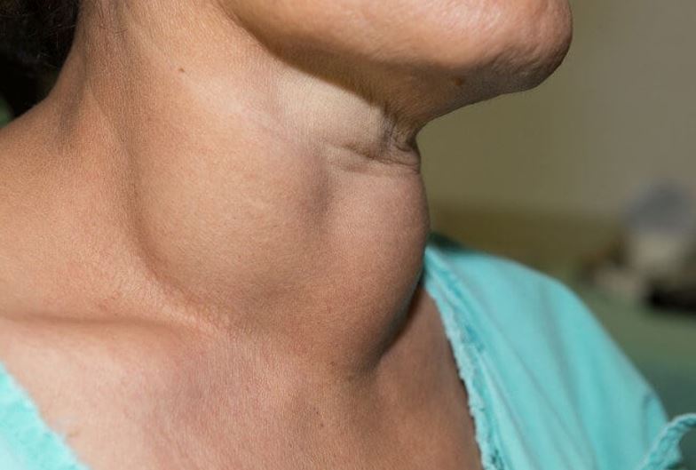 Người mắc bệnh ung thư tuyến giáp giai đoạn đầu thường xuất hiện khối u trên cổ