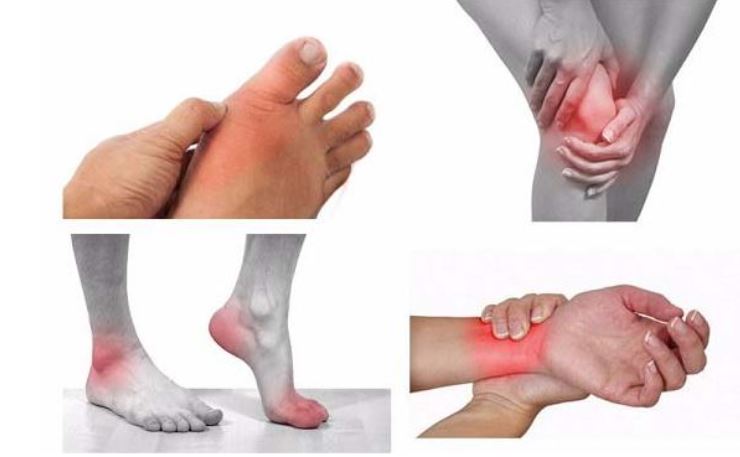 Nguyên nhân gây ra bệnh gout