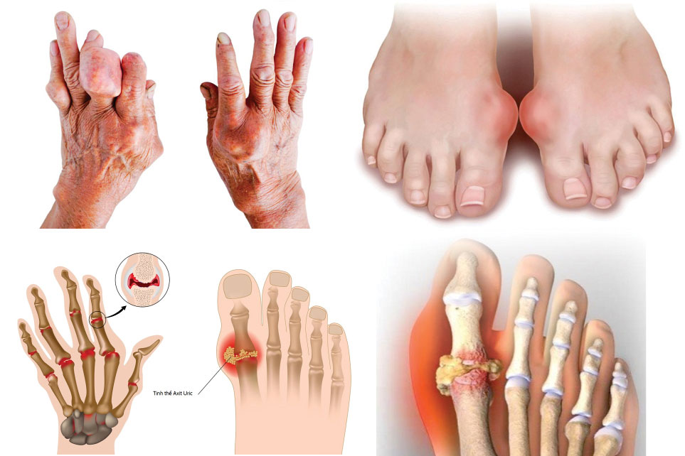 Phương pháp điều trị hiệu quả cho tình trạng gout