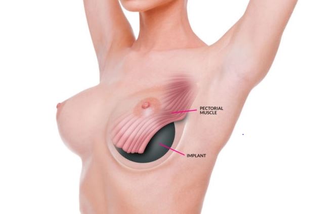 Nâng ngực là kiểu phẫu thuật thẩm mỹ phổ biến nhất nhằm giúp chị em phụ nữ quyến rũ và tự tin