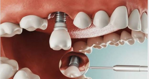 Trụ răng Implant là một trụ kim loại được cấy ghép vào xương hàm