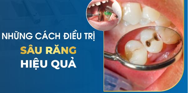 9 cách trị sâu răng đơn giản tại nhà mà mang lại hiệu quả cao