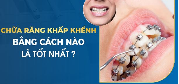 Niềng răng và bọc răng sứ là cách khắc phục tình trạng răng khểnh