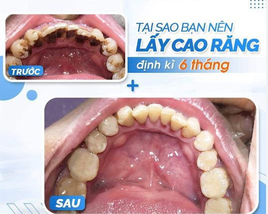 Thời điểm lấy cao răng thích hợp từ 3-6 tháng/lần